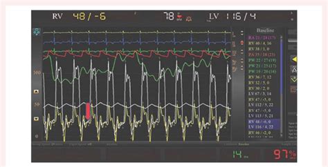 lv pressure tracing|lvedp catheterization.